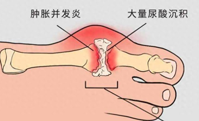 尿酸高“元凶”揭秘！这些习惯不改，痛风迟早“找上门”