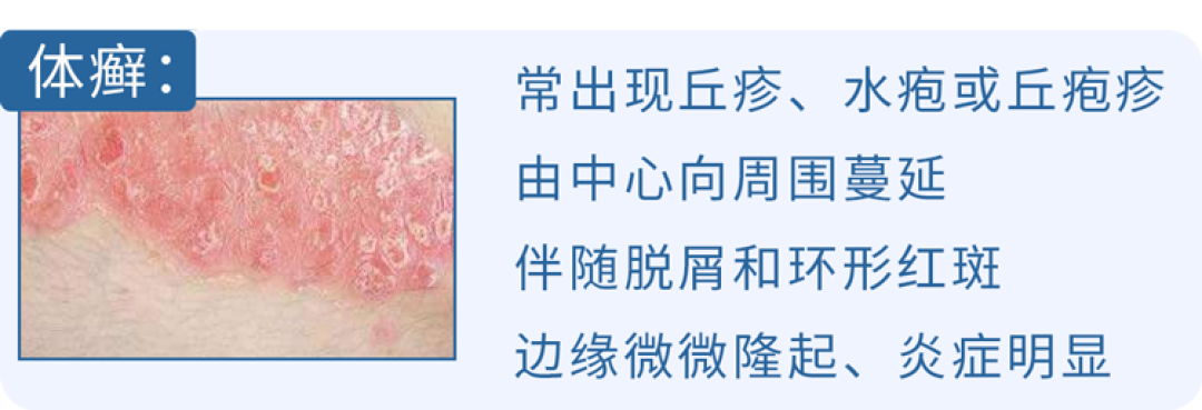 女子闻刚脱下的袜子,竟感染真菌肺炎?提醒:这些东西千万别乱摸乱闻