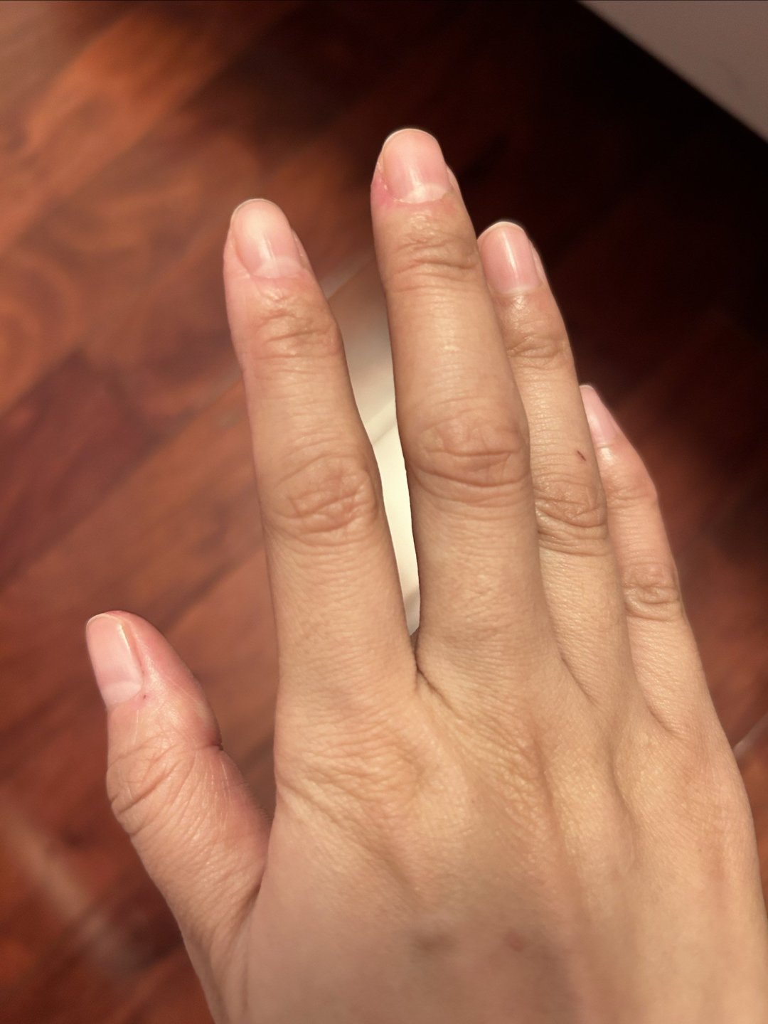 手上老是长倒刺,怎么办