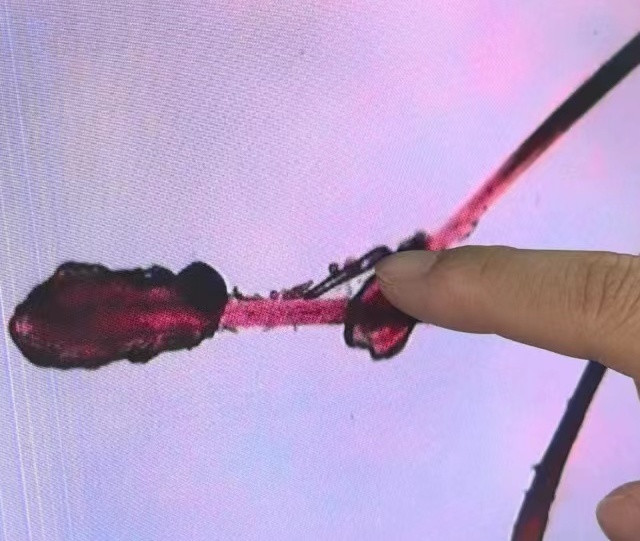 螨虫型干眼症检查治疗全攻略！！