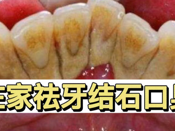 牙结石口臭有救了！学会这3找！轻松搞定不复发