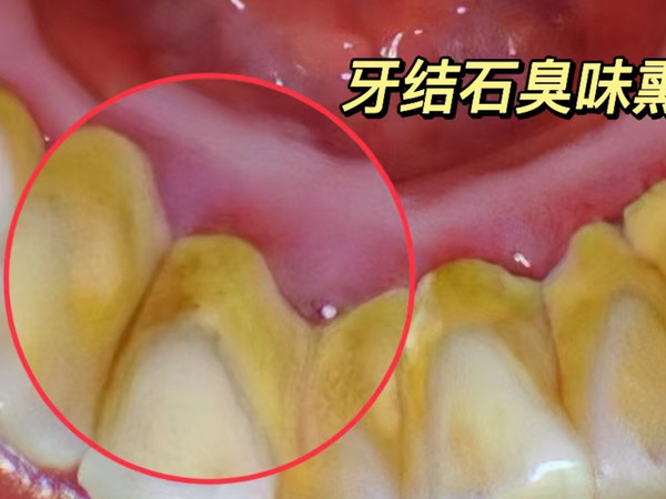 有牙结石口臭太尴尬！3招带你根治