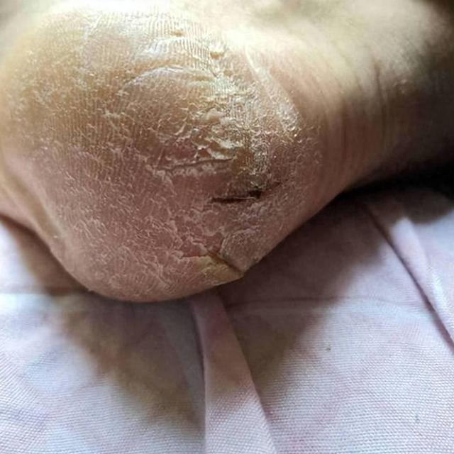 过来人的祛裂经验曝光！简单3步根治脚后跟干裂！还不抓紧码住！