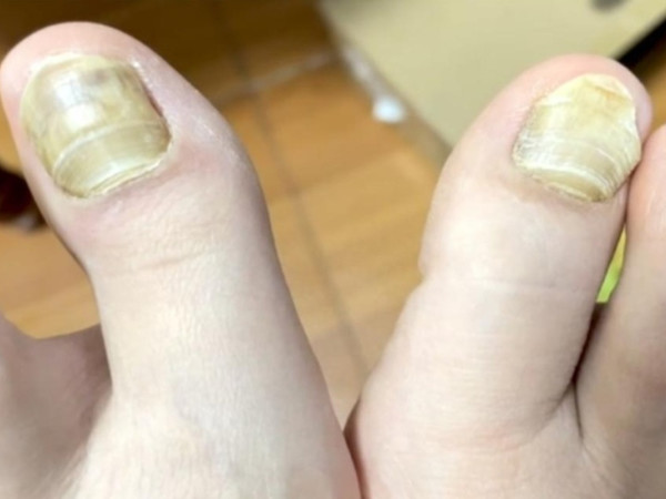 消除灰指甲我有话说！