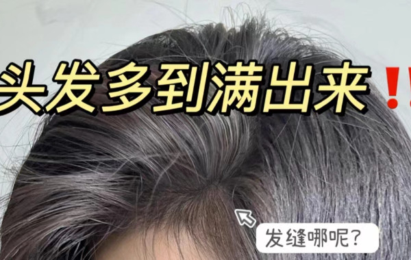 防脱三个月，终于迎来了发量巅峰！