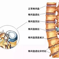 腰间盘突出该怎么样养护？15大护理知识点速速收藏