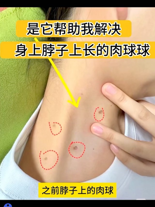 脖子上褐色的小肉丁别扣，这样正确处理。