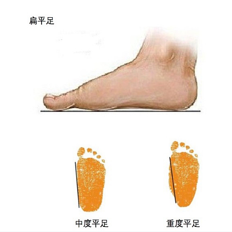 【扁平足】有足弓的你也有可能是扁平足？5年康复师带你了解扁平足，内附自我纠正指南！