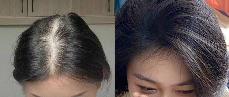 生发奇迹!3个方法拯救宽发缝、狂掉发,过来亲测有效不看后悔!_护发产品_什么值得买