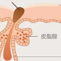 不用手挤，才是去黑头的靠谱方法