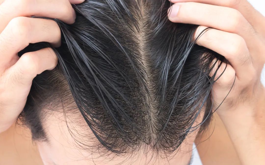 用这个方法让你头发不易出油！头皮敏感、油扁塌、头屑头痒也能得到解决~