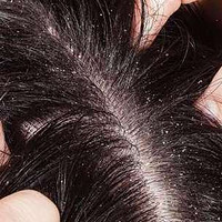 为什么会有头皮屑？13大头发护理害处风险千万警惕！