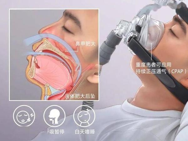 呼吸机是智商税还是治疗睡眠呼吸暂停综合症的好物？呼吸机有没有依赖性？靠谱的呼吸机求推荐？