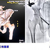 智能精准 加速康复！新晨医院完成黄山首台骨盆骨折机器人辅助下闭合复位螺钉内固定手术