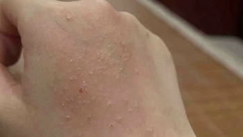 抗争几年的湿疹，被它轻松拿捏，又痒又红就用它！