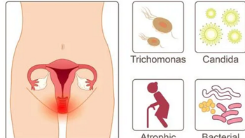 外阴瘙痒？患霉菌性阴道炎这些知识你需要知道