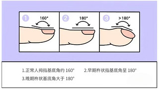 杵状指是心脏在求救，自查一下