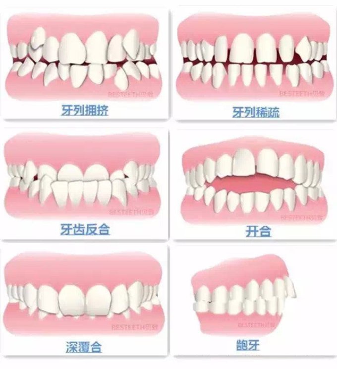 牙齿矫正