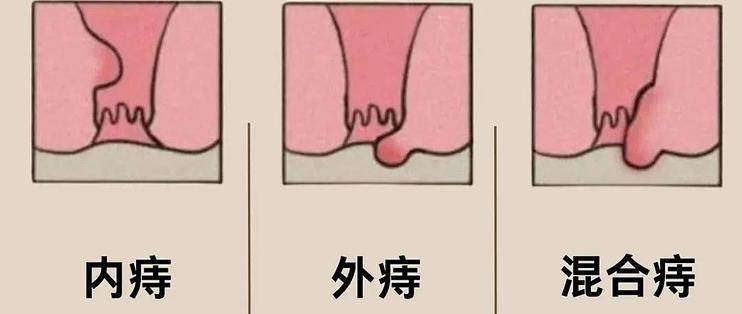 痔疮的3种类型,一分钟帮你分清,快看看你属于哪一种?_日常用药_什么值得买