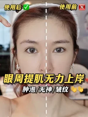 眼周提肌无力上岸了，总算可以不用抬眉毛睁眼了。#眼部抗衰 #花至肌提美容仪 #眼纹 #肌肉抗老