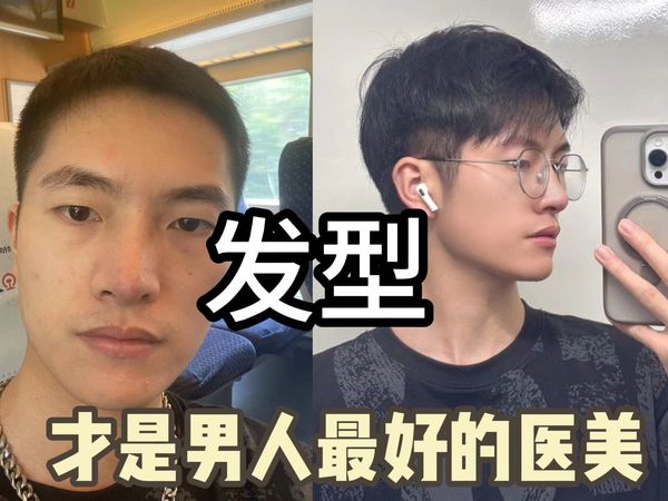 用米诺地尔头发会掉光？别被资本洗脑了！新手懒人生发秘籍大公开