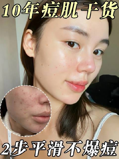 作为一位油痘肌,我经常面临长痘的问题。但是,通过尝试各种痘肌护肤品,我发现科颜氏的金盏花乳是我最满意的选择。科颜氏这个品牌一直是我信赖的品牌之一,而这款金盏花乳更是让我觉得物超所值。关于如何拯救痘痘肌