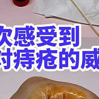 第一次感受到碘伏对痔疮的威力！重度痔疮去痔方法！