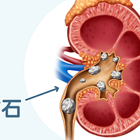 震惊！为什么越来越多的人得肾结石？赶紧听听劝告吧，这2个习惯千万要改掉！