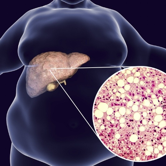 不就脂肪肝么，一个月时间，用这几个办法轻松拿捏！