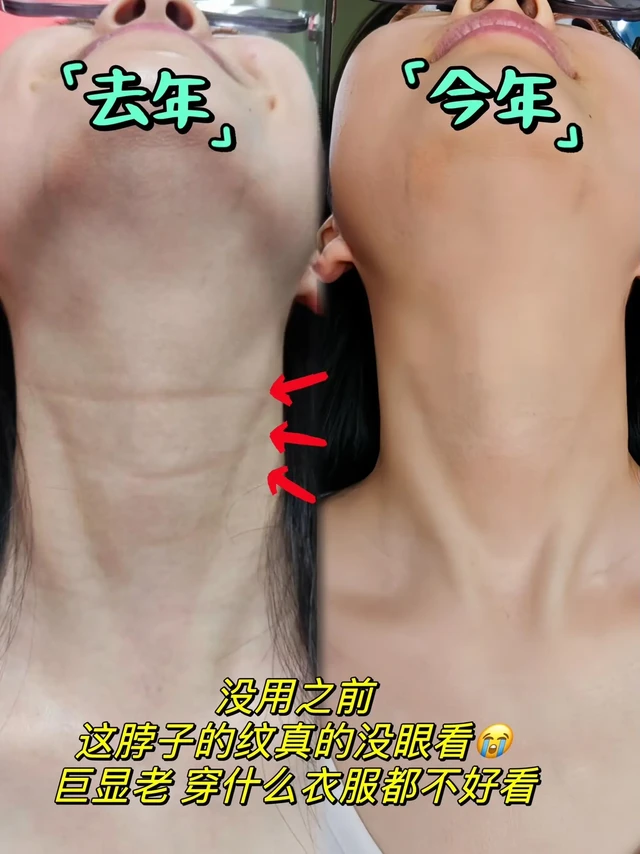 女人上了年纪之后一定要保养脖子。要不然你的年龄一不子就被看出来了。我现在每天晚上都会抹这个SDX颈纹霜,它真的特别好吸收,涂完以后脖子嫩嫩的,摸起来也滑溜溜的,它的质地特别的细腻滋润,涂抹的时候就能感