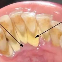 超详细！终于有人把牙结石说清楚了！！！