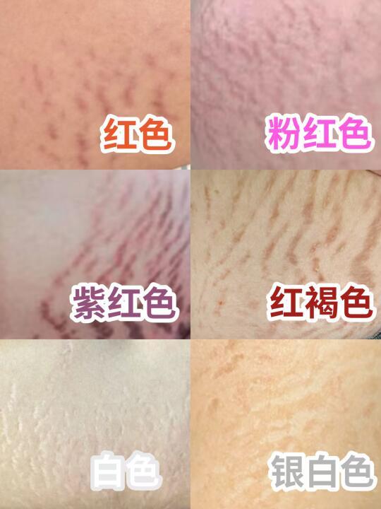 孕妈必备！选择妊娠油要看成分不踩雷