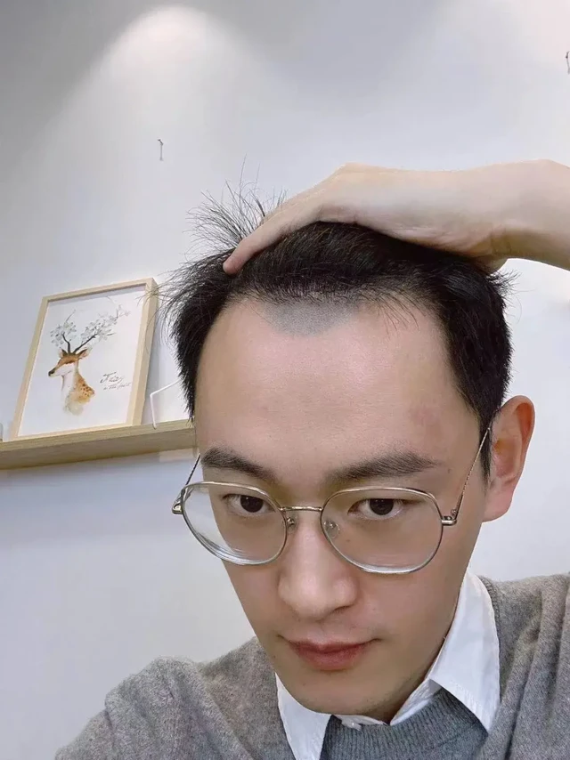 对于脱发是越早治疗越好恢复，如果你已经出现明显的发际线/两额角后移，[拔草R]植发也是一种不错的治疗方法。
	
分享杨先生在雍禾植发10个月效果给大家[红书R]之前他对植发不太了解，担心植发的副作用和