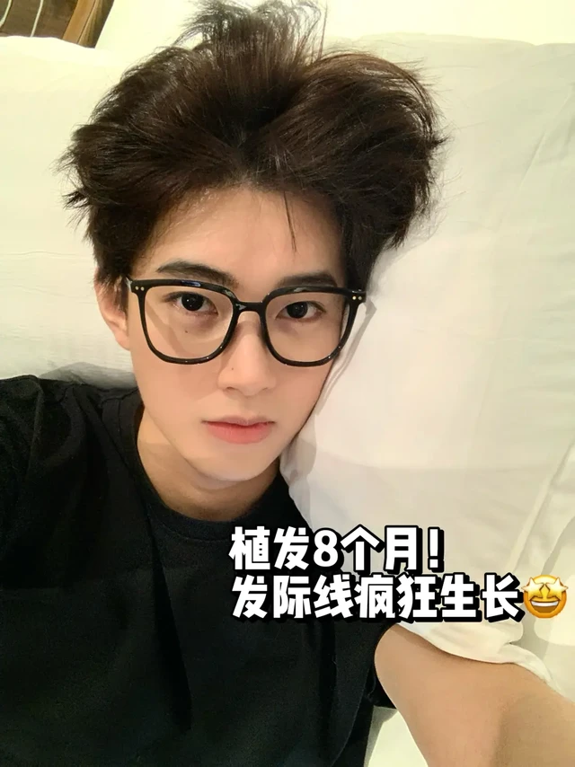 👉想帅出圈？植发半年后帅到不敢低调🫢