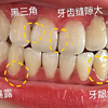 终于上岸了！牙龈萎缩刷到这篇码住！不删！