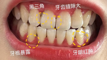 终于上岸了！牙龈萎缩刷到这篇码住！不删！