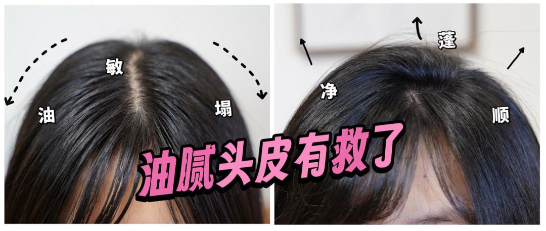 去屑洗发水选购指南:成分解析与品牌推荐