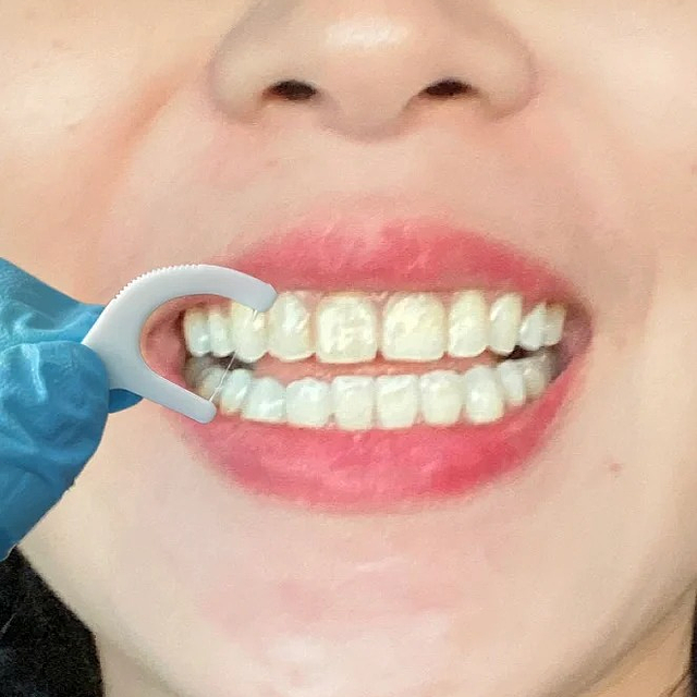 想摆脱重度牙黄，牙结石？这个方法，都去试试！！