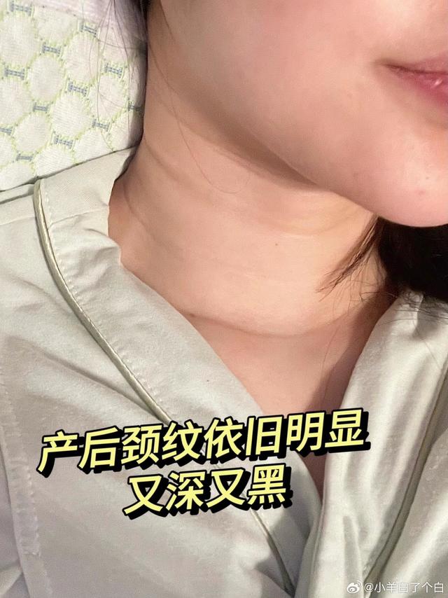 去除“妈”感,产后逆袭天鹅颈!!我是属于颈纹天生就比较重从小颈纹就好明显怎么没人告诉我怀孕颈纹也会加重啊!入手了网上风很大的SDX颈霜说是平价又好用 用了一个月时间颈纹真的浅了好多对于我这个颈纹资深患