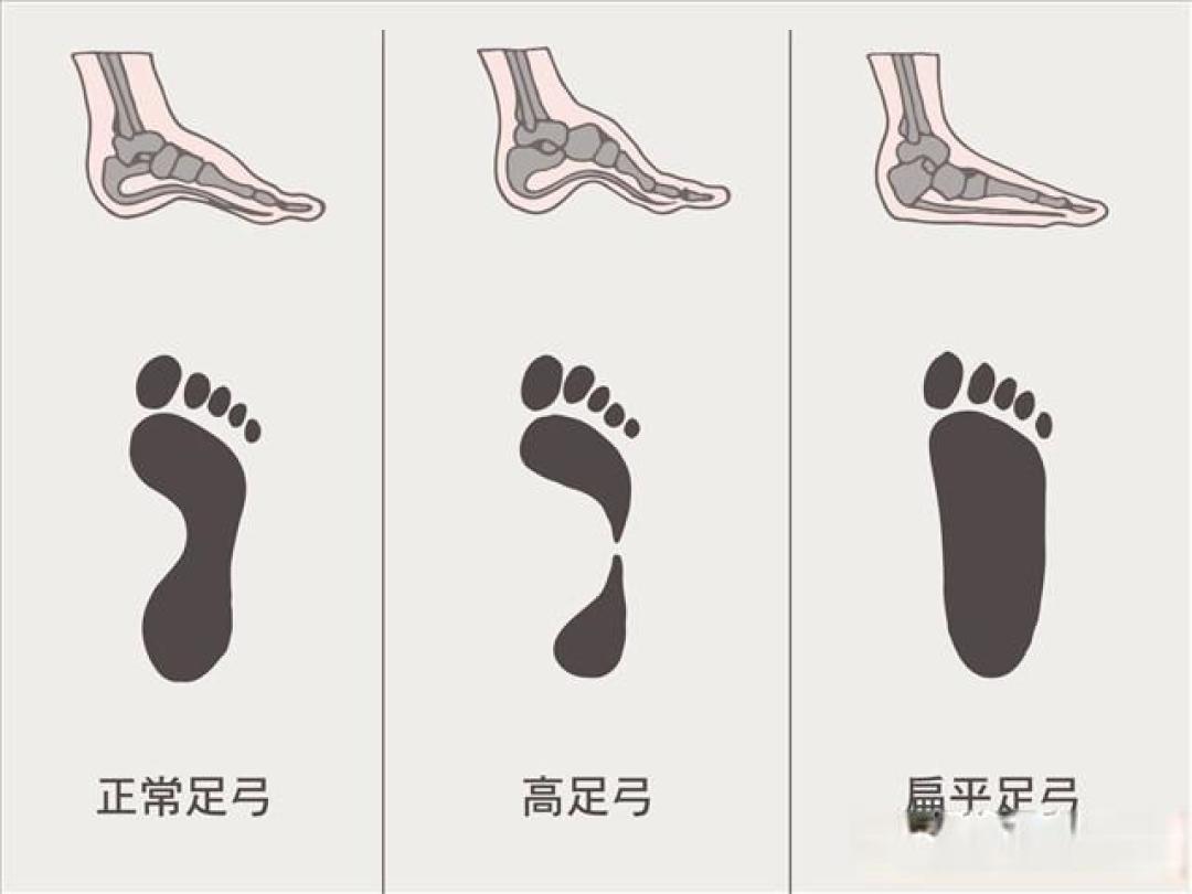跑鞋挑选指南:类型、足弓、脚型、体重全方位考虑
