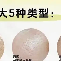 毛孔粗大的原因 看你踩雷了几个