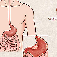 胃癌盯上年轻人！健康生活刻不容缓！