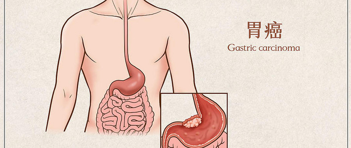 胃癌盯上年轻人！健康生活刻不容缓！