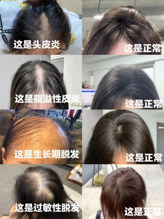 方法奇怪但可以改善脱发的方式（头发篇） 以