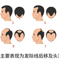 告别秃头，米诺地尔的秘密武器