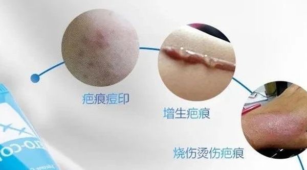 医美术后疤痕管理全指南：如何正确处理和预防？