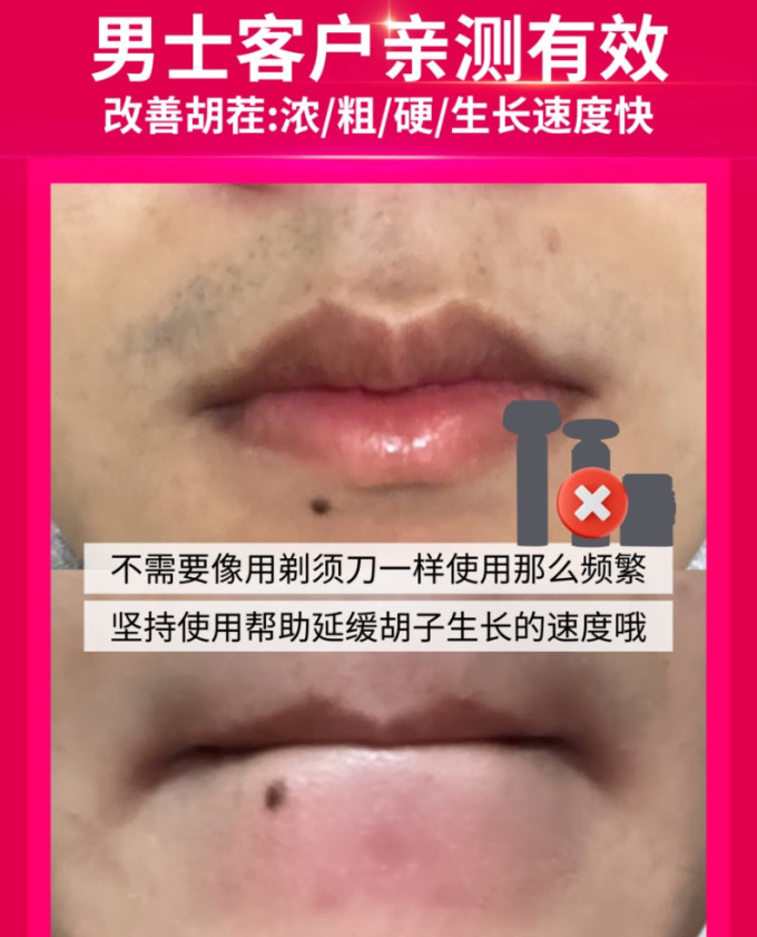 脱毛器