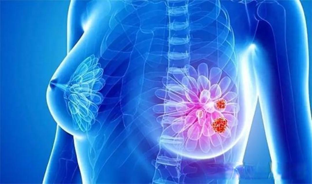 乳腺癌谣言TOP5:这些误区你可能还在信