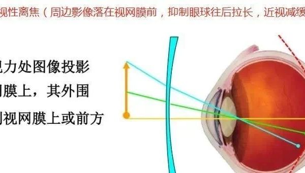 【最全】离焦、环焦、全焦镜片,你都了解吗?