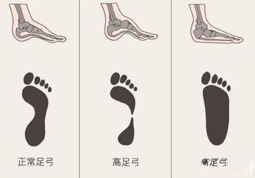 跑步鞋选购避坑指南:从脚型到场景的三大黄金法则